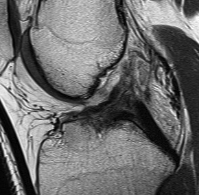 ACL MRI Femoral ACL Avulsion